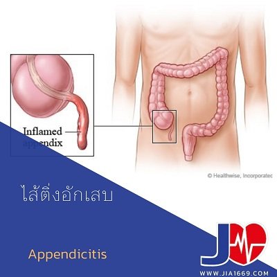 ไส้ติ่งอักเสบ Appendicitis ไส้ติ่งอักเสบ Appendicitis