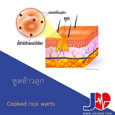 หูดข้าวสุก หูดข้าวสุก