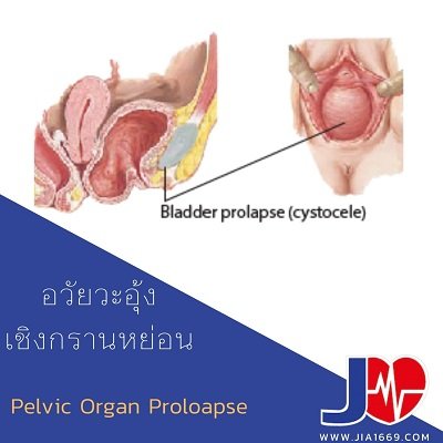 อวัยวะอุ้งเชิงกรานหย่อน Pelvic Organ Prolapse อวัยวะอุ้งเชิงกรานหย่อน Pelvic Organ Prolapse