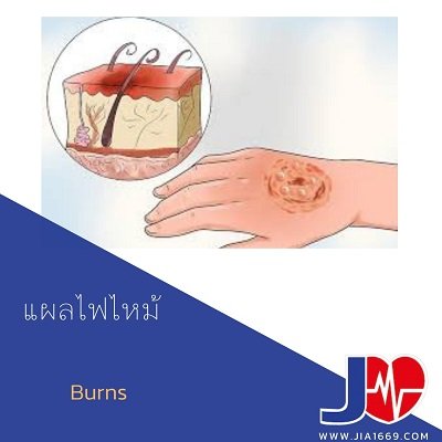 Burns  Burns