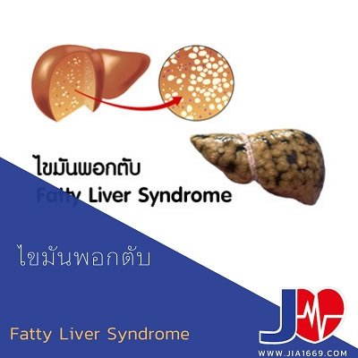 fatty liver disease fatty liver disease