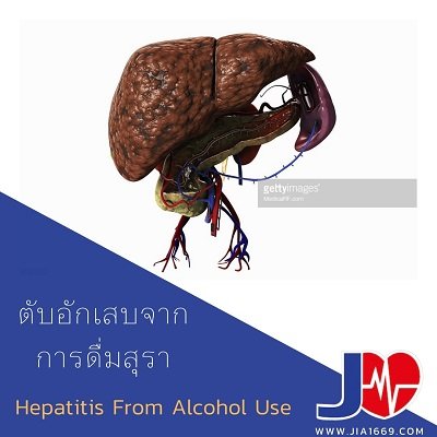 Hepatitis from alcohol use Hepatitis from alcohol use