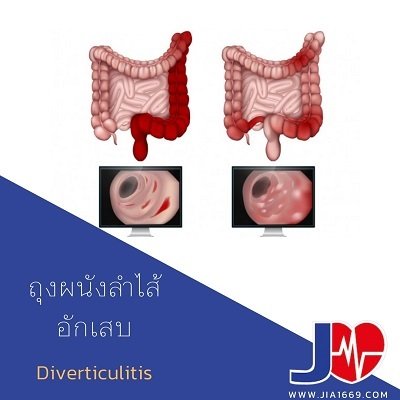 โรคถุงผนังลำไส้อักเสบ(Diverticulitis) โรคถุงผนังลำไส้อักเสบ(Diverticulitis)