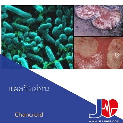 แผลริมอ่อน แผลริมอ่อน