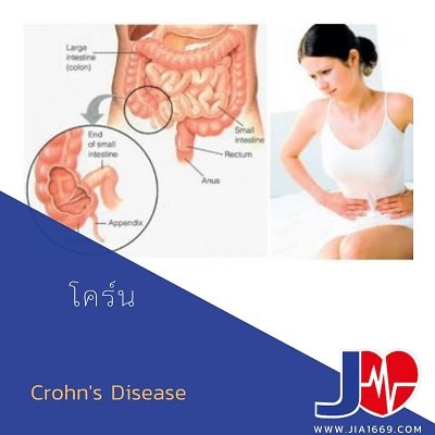 โรคโคร์น(Crohn's Disease) โรคโคร์น(Crohn's Disease)