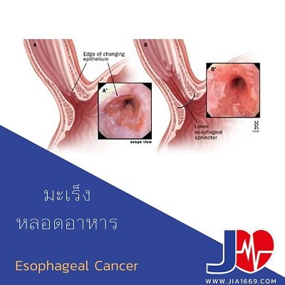 มะเร็งหลอดอาหาร(esophageal cancer) มะเร็งหลอดอาหาร(esophageal cancer)