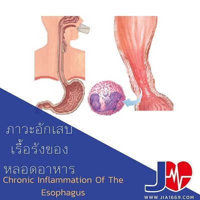 ภาวะอักเสบเรื้อรังของหลอดอาหาร ภาวะอักเสบเรื้อรังของหลอดอาหาร