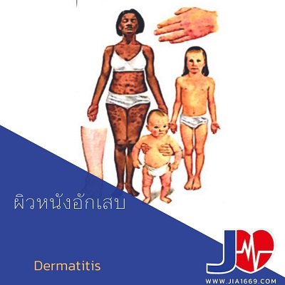 dermatitis