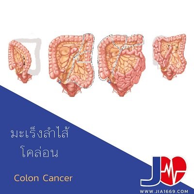มะเร็งลำไส้โคล่อน มะเร็งลำไส้โคล่อน