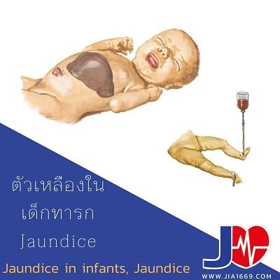 Jaundice Jaundice