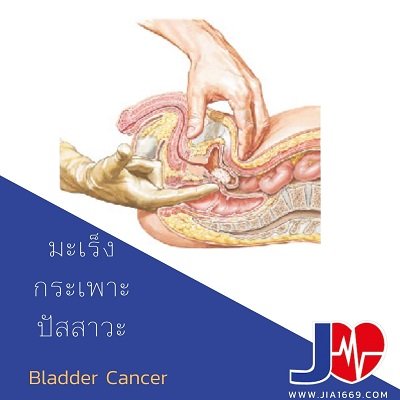 มะเร็งกระเพาะปัสสาวะ Bladder Cancer  มะเร็งกระเพาะปัสสาวะ Bladder Cancer