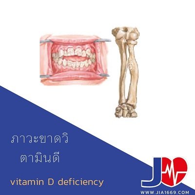 ภาวะขาดวิตามินดี ภาวะขาดวิตามินดี