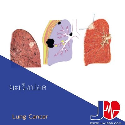 lung cancer lung cancer