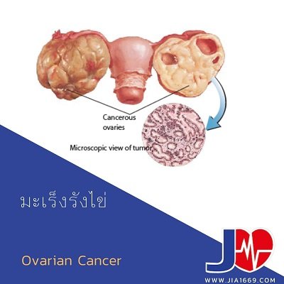 มะเร็งรังไข่ Ovarian Cancer