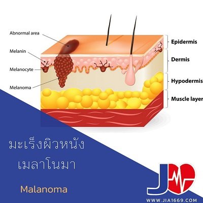 มะเร็งผิวหนังเมลาโนมา มะเร็งผิวหนังเมลาโนมา