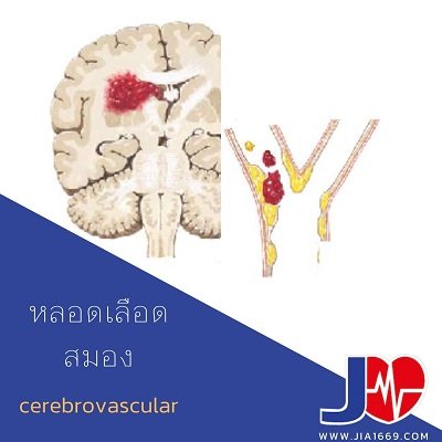 โรคหลอดเลือดสมอง โรคหลอดเลือดสมอง
