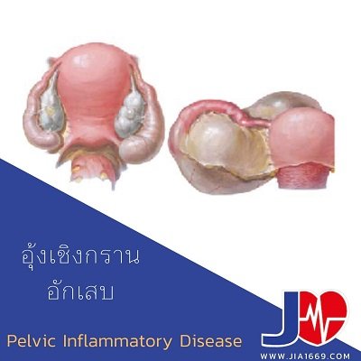 อุ้งเชิงกรานอักเสบ Pelvic Inflammatory Disease อุ้งเชิงกรานอักเสบ Pelvic Inflammatory Disease