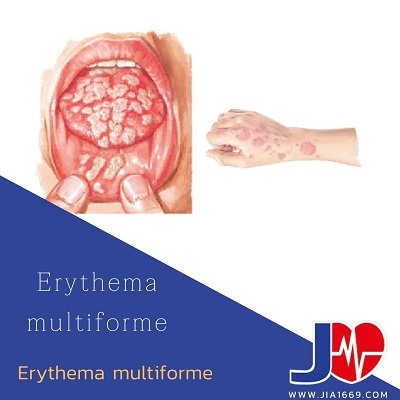 Erythema multiforme Erythema multiforme