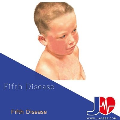 Fifth Disease โรคฟิฟธ์ Fifth Disease โรคฟิฟธ์