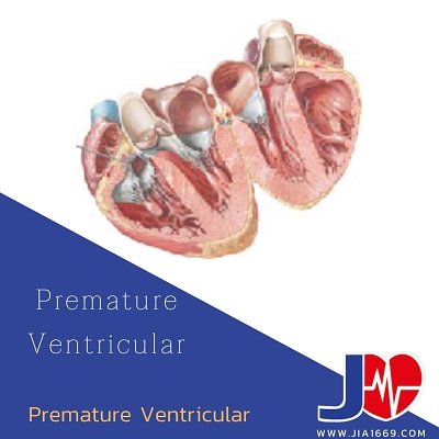 Premature Ventricular Contractions (PVCs) Premature Ventricular Contractions (PVCs)