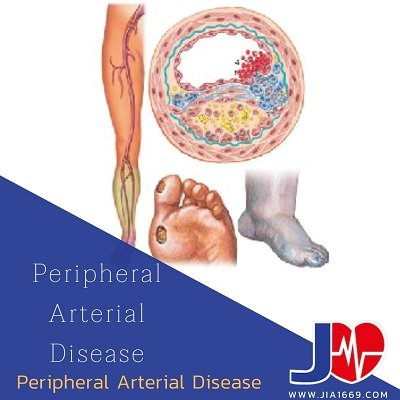 peripheral arterial disease โรคหลอดเลือดแดงส่วนปลาย peripheral arterial disease โรคหลอดเลือดแดงส่วนปลาย