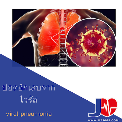 ปอดอักเสบจากไวรัส(Pneumonia) ปอดอักเสบจากไวรัส(Pneumonia)