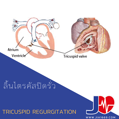 ลิ้นไตรคัสปิดรั่ว ลิ้นไตรคัสปิดรั่ว