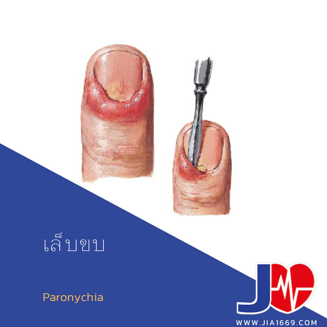 เล็บขบ เล็บขบ