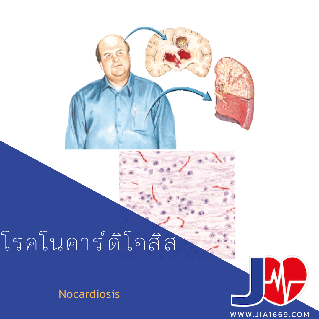 โรคโนคาร์ดิโอสิส โรคโนคาร์ดิโอสิส