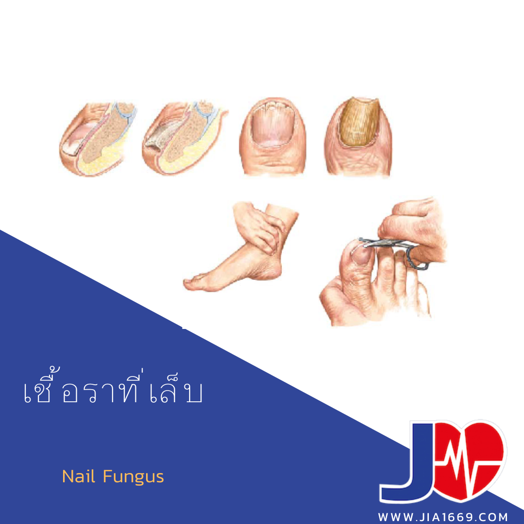 Nail Fungus 