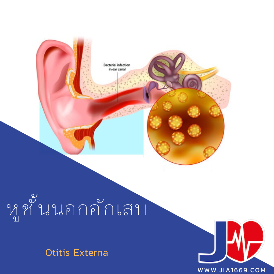 หูชั้นนอกอักเสบ  หูชั้นนอกอักเสบ