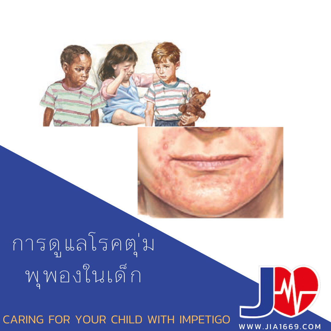 การดูแลโรคตุ่มพุพองในเด็ก การดูแลโรคตุ่มพุพองในเด็ก