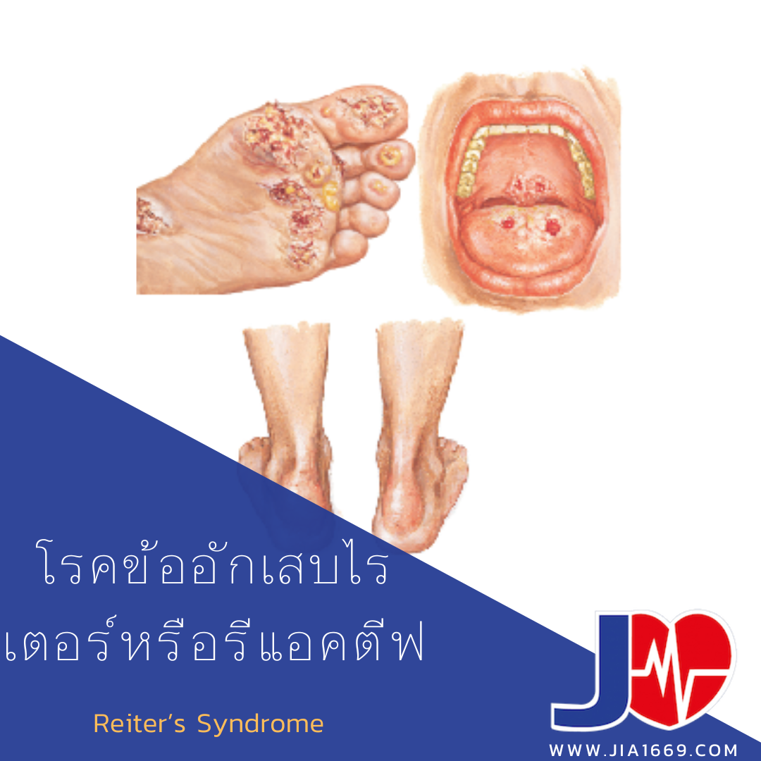 โรคข้ออักเสบไรเตอร์หรือรีแอคตีฟ โรคข้ออักเสบไรเตอร์หรือรีแอคตีฟ