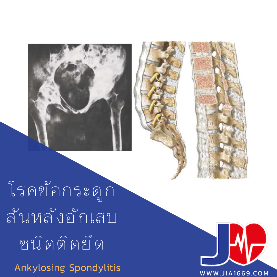 โรคข้อกระดูกสันหลังอักเสบชนิดติดยึด โรคข้อกระดูกสันหลังอักเสบชนิดติดยึด