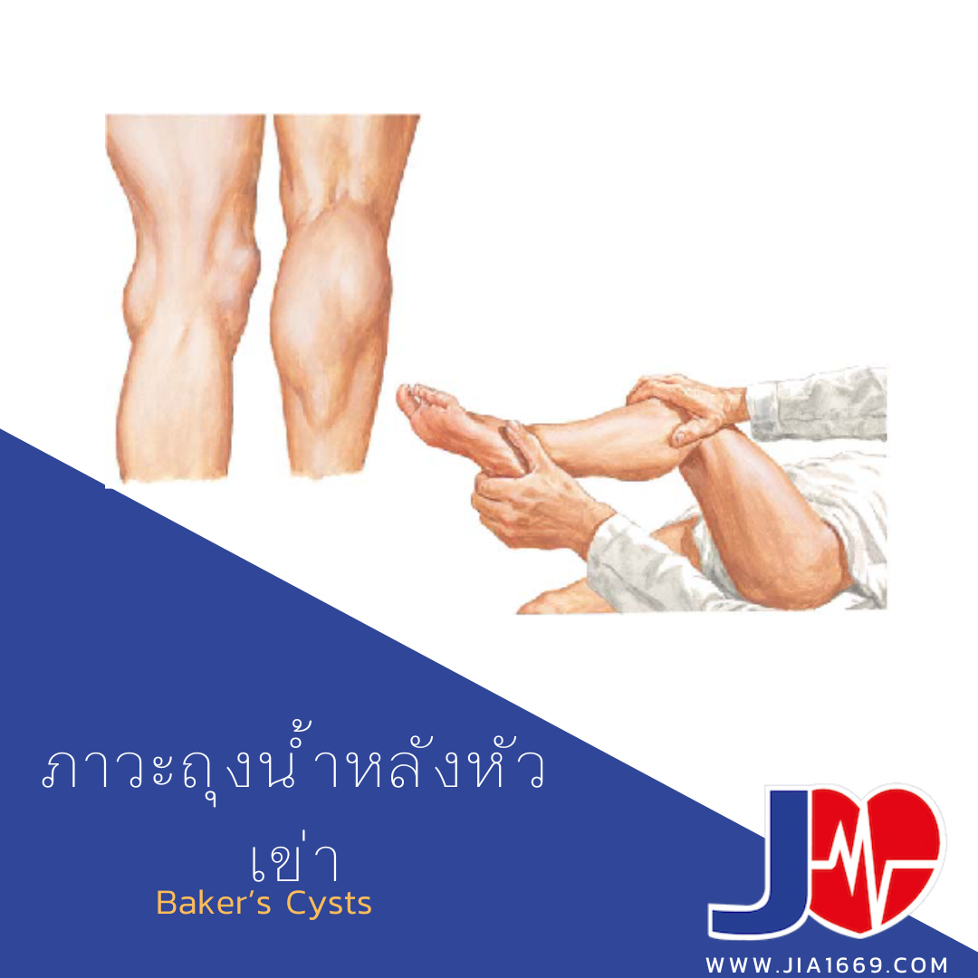 ภาวะถุงน้ำหลังหัวเข่า ภาวะถุงน้ำหลังหัวเข่า