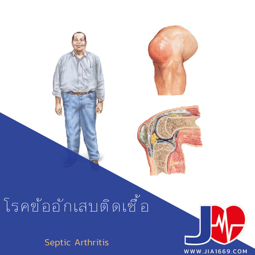 โรคข้ออักเสบติดเชื้อ โรคข้ออักเสบติดเชื้อ