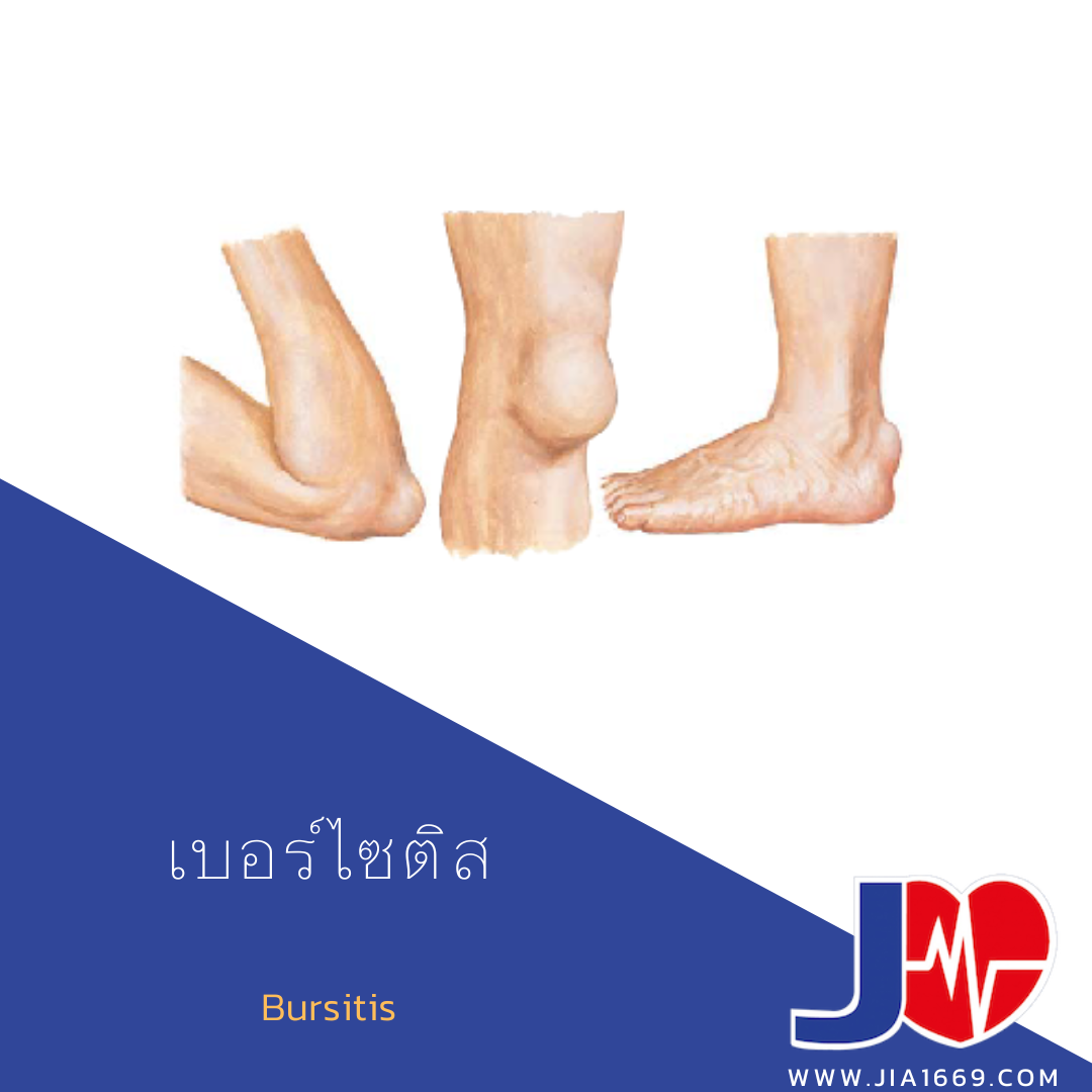 เบอร์ไซติส เบอร์ไซติส