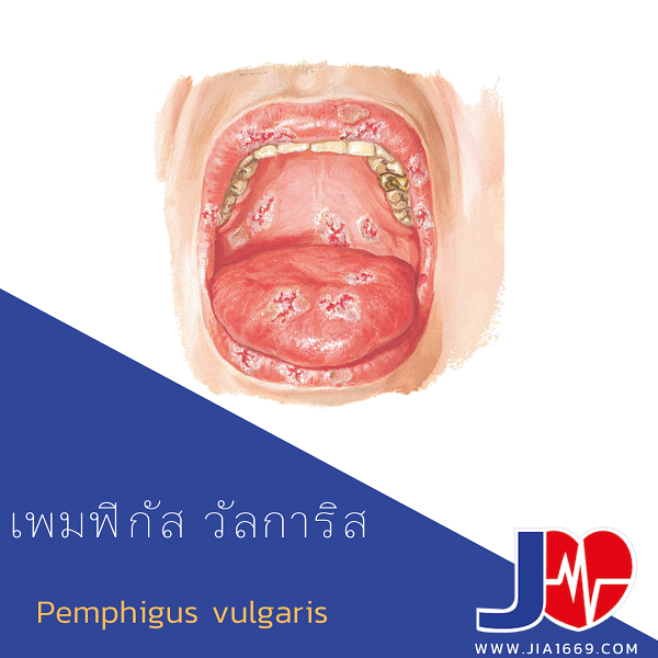 เพมฟิกัส วัลการิส เพมฟิกัส วัลการิส