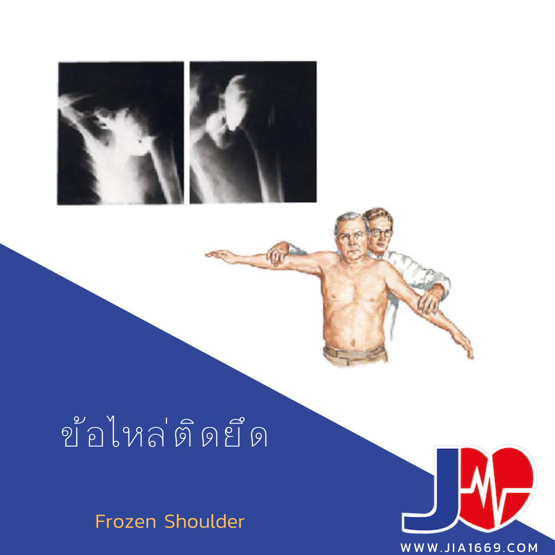 ข้อไหล่ติดยึด ข้อไหล่ติดยึด