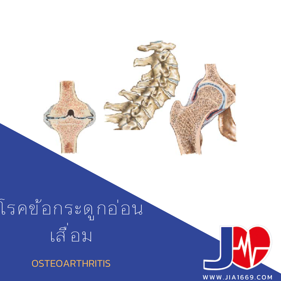 โรคข้อกระดูกอ่อนเสื่อม  โรคข้อกระดูกอ่อนเสื่อม