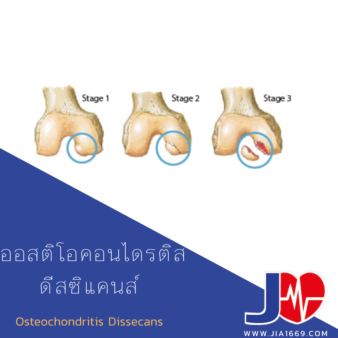Osteochondritis Dissecans 