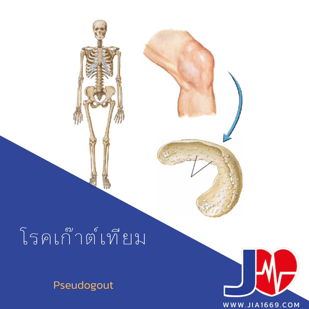 โรคเก๊าต์เทียม โรคเก๊าต์เทียม