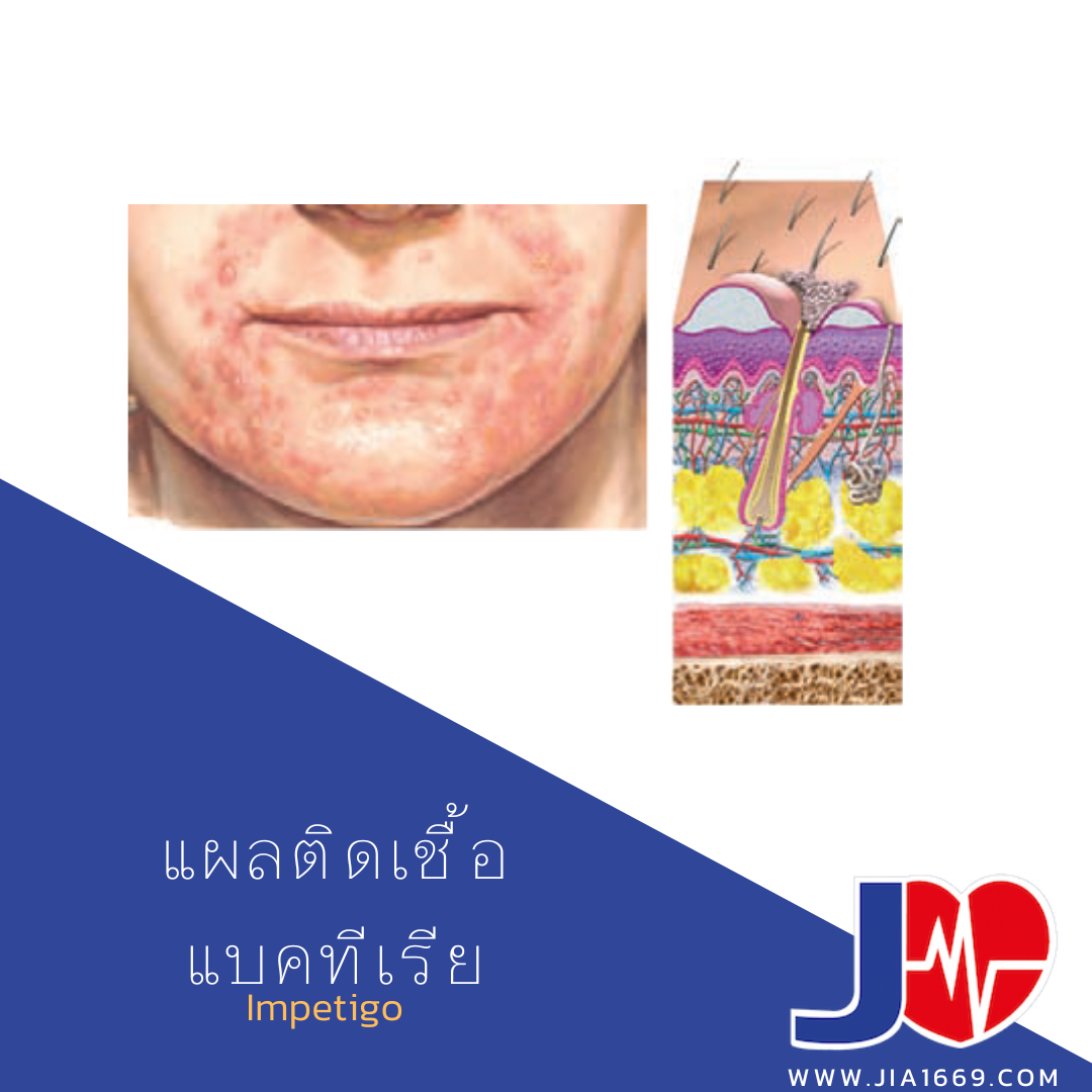 แผลติดเชื้อแบคทีเรีย แผลติดเชื้อแบคทีเรีย
