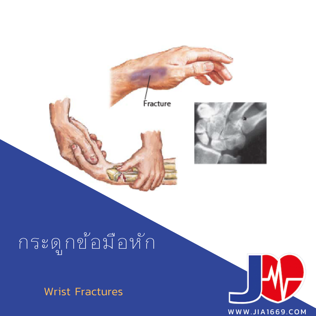 กระดูกข้อมือหัก กระดูกข้อมือหัก