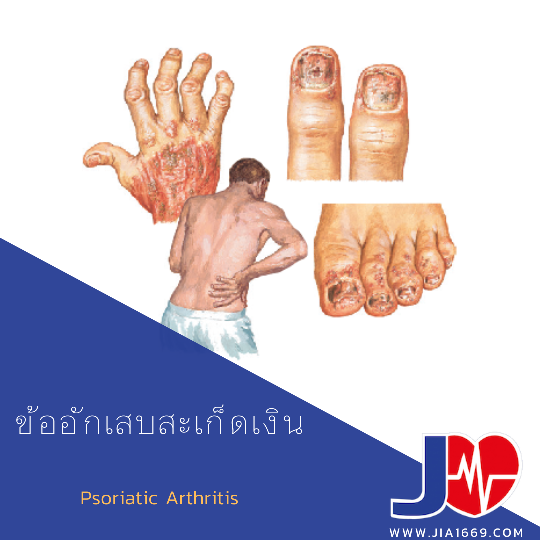 ข้ออักเสบสะเก็ดเงิน ข้ออักเสบสะเก็ดเงิน