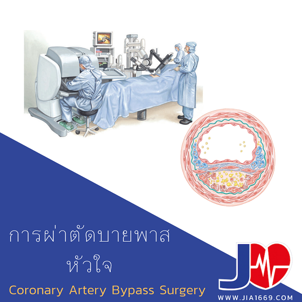การผ่าตัดบายพาสหัวใจ การผ่าตัดบายพาสหัวใจ