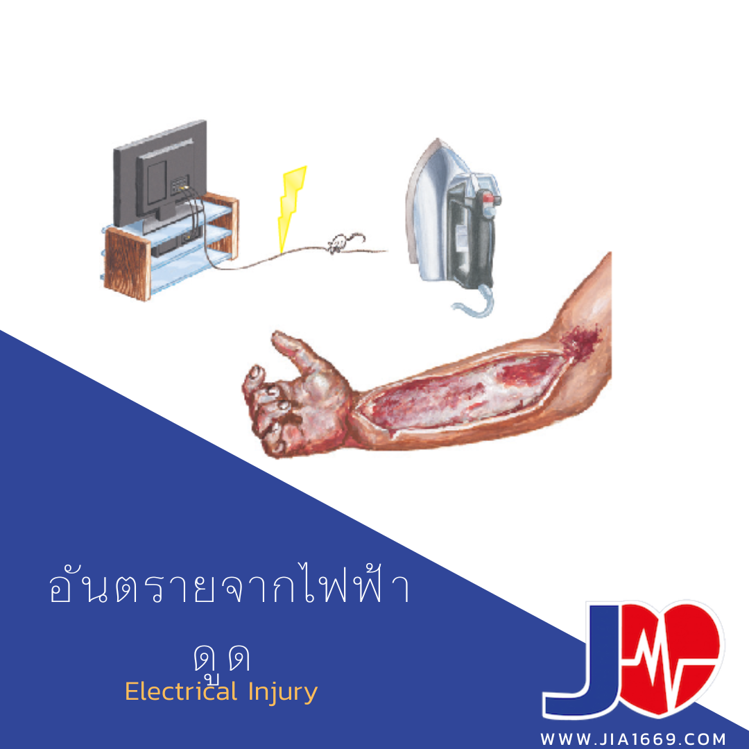อันตรายจากไฟฟ้าดูด อันตรายจากไฟฟ้าดูด
