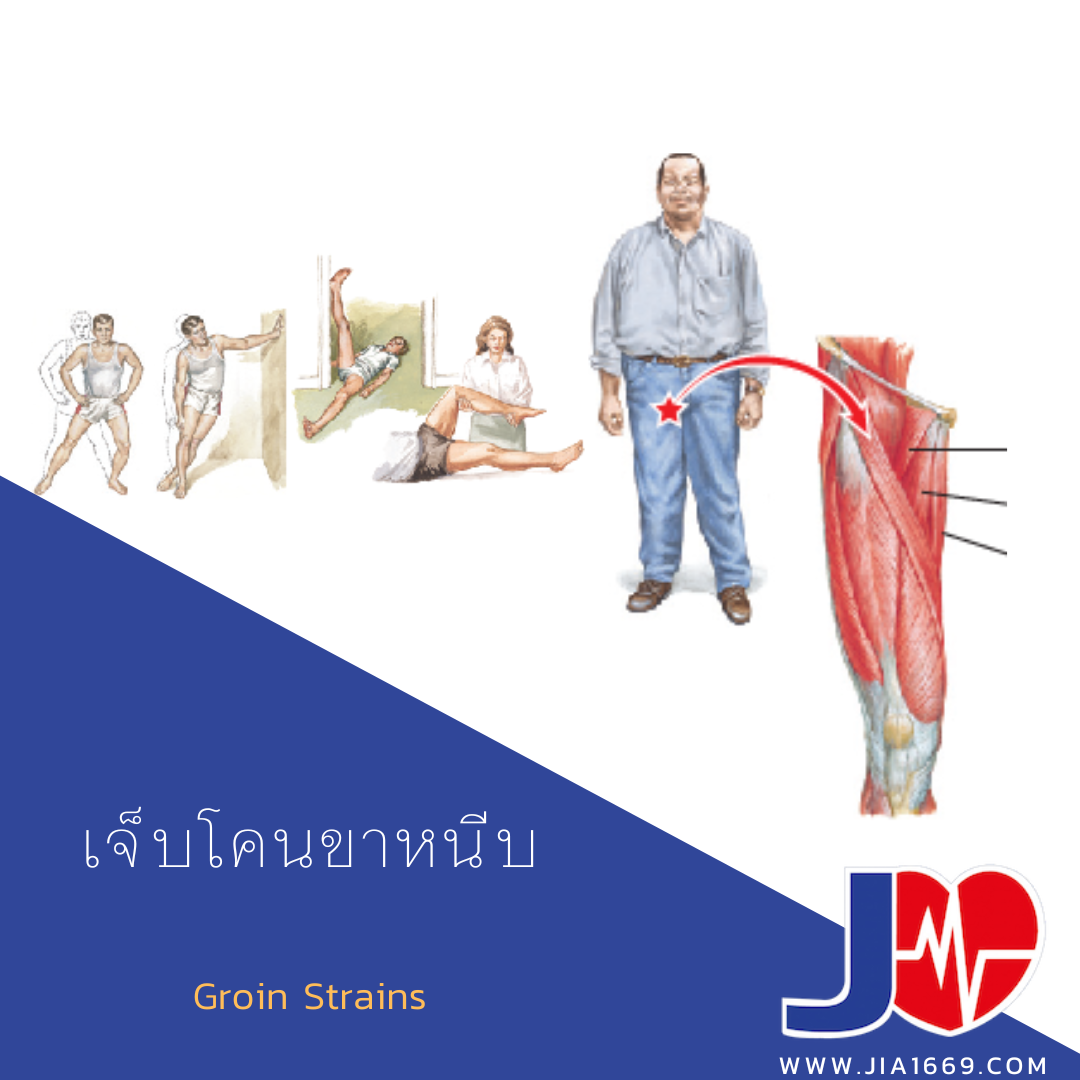 เจ็บโคนขาหนีบ เจ็บโคนขาหนีบ
