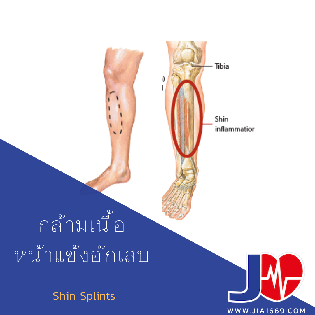 กล้ามเนื้อหน้าแข้งอักเสบ กล้ามเนื้อหน้าแข้งอักเสบ
