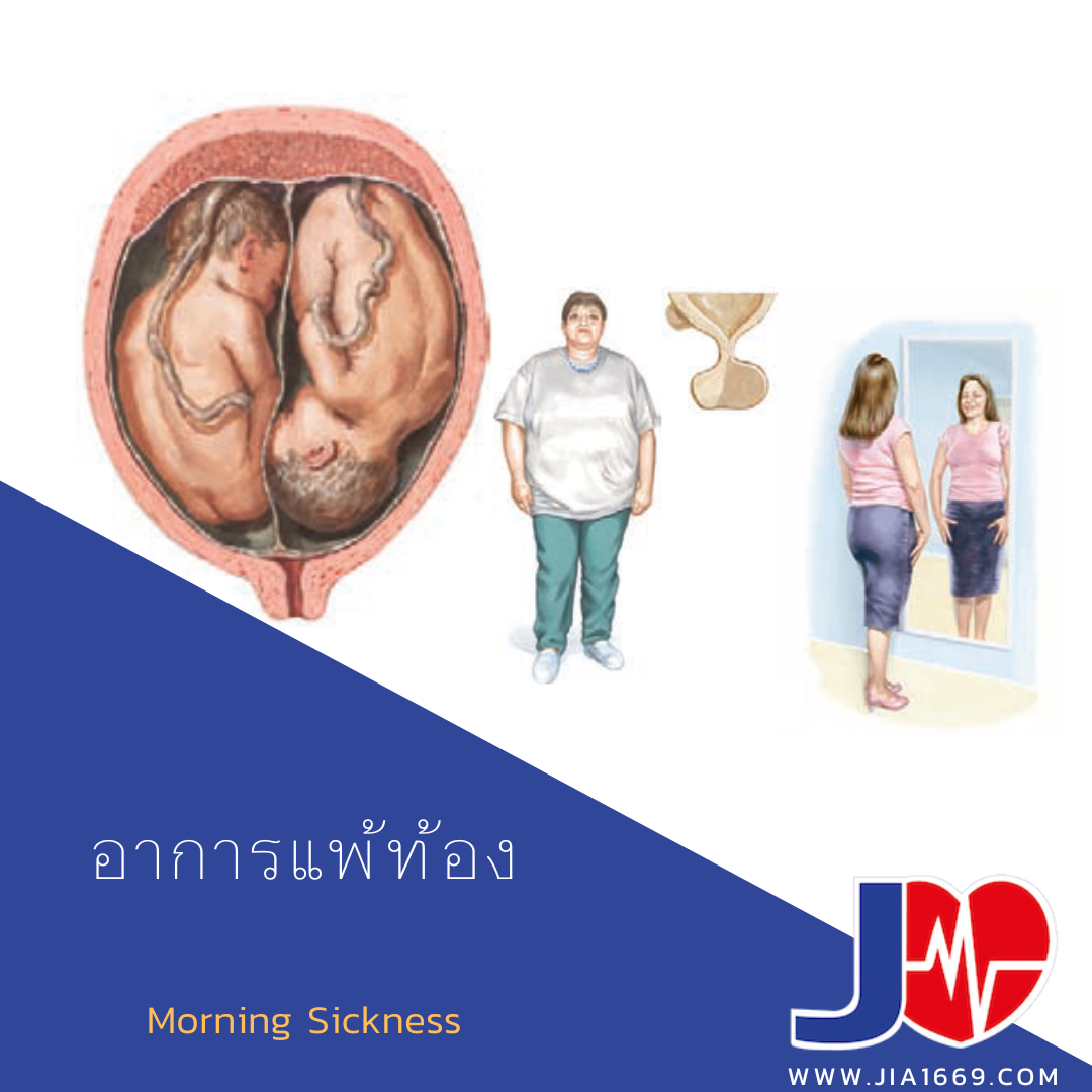 อาการแพ้ท้อง อาการแพ้ท้อง